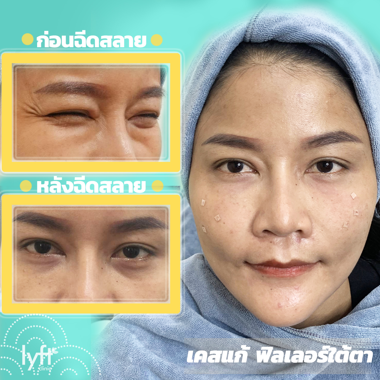 ฉีดฟิลเลอร์แล้วบวม ฉีดสลายฟิลเลอร์ได้ไหม