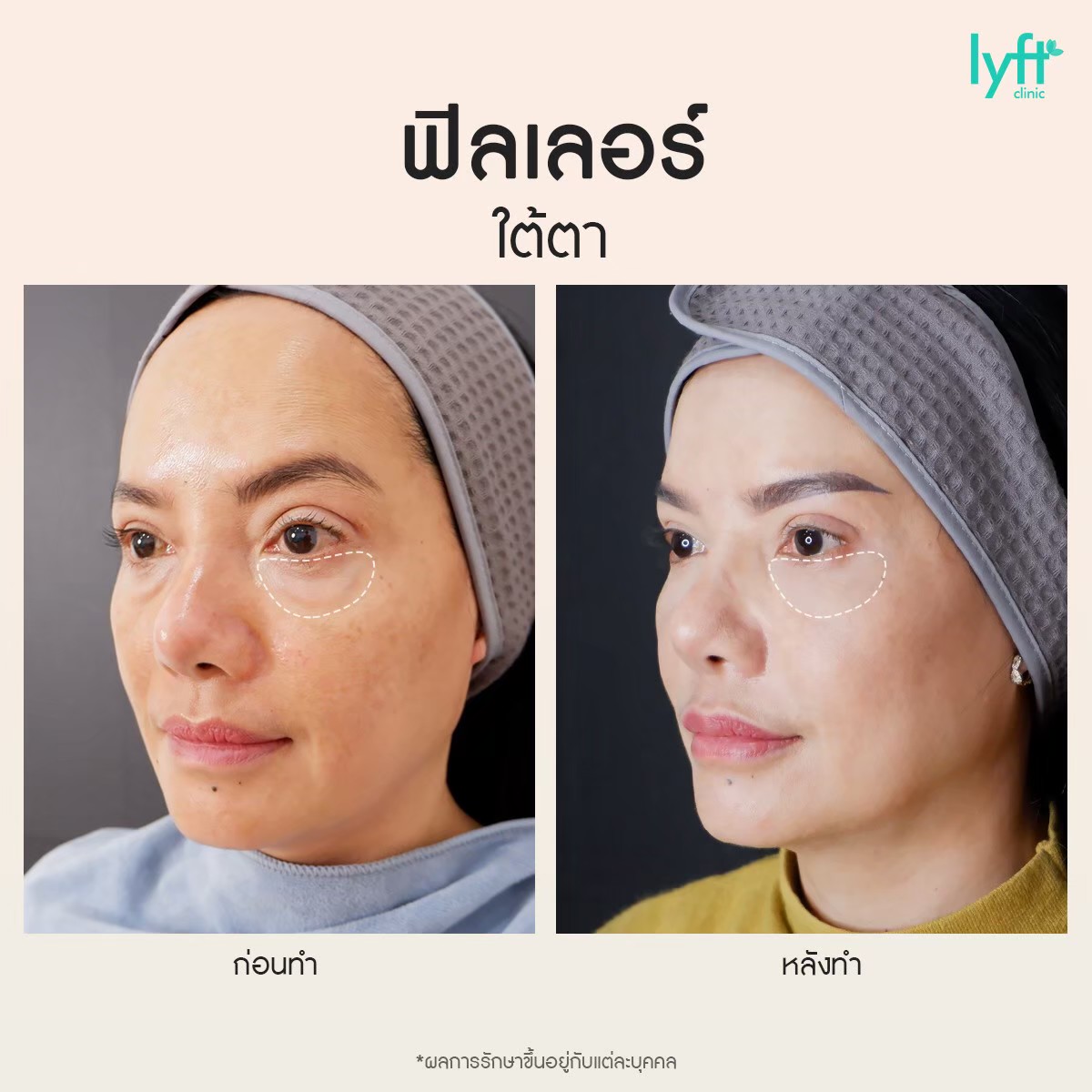 LINE_ALBUM_ลงเพจ กุมภาพันธ์????_๒๓๐๑๐๔_1.jpg