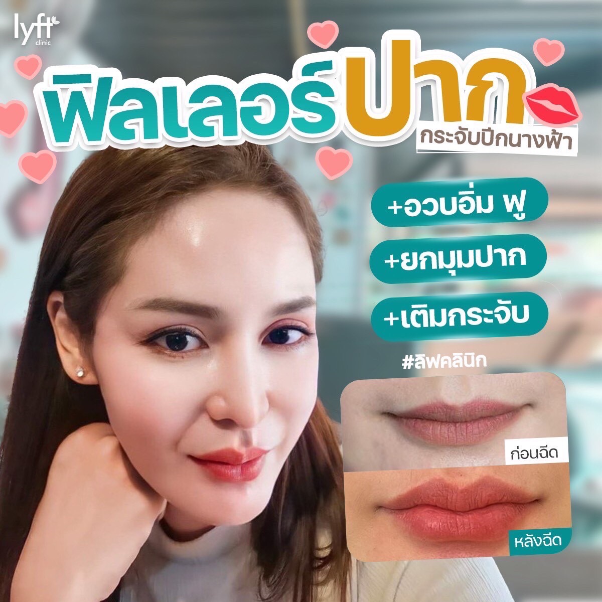รีวิวฟิลเลอร์ปากเคส8